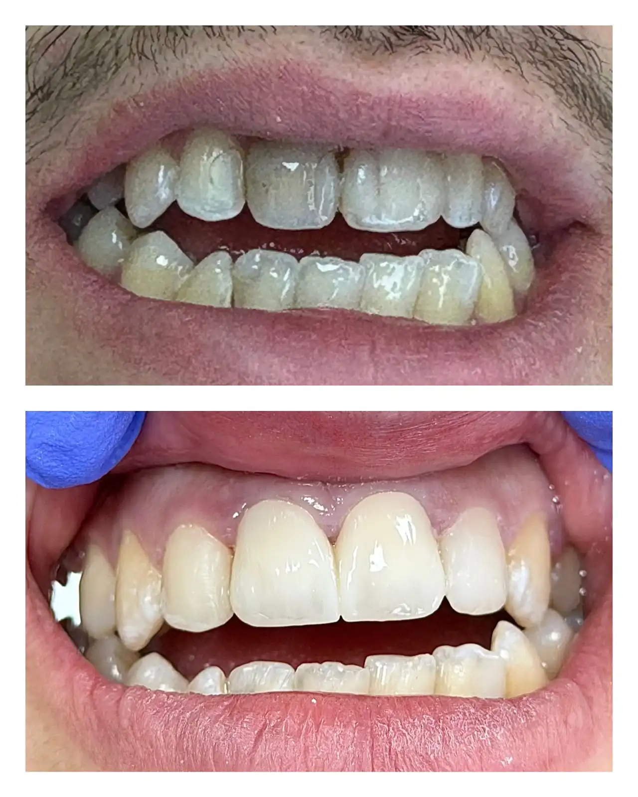 Avant / après dentisterie esthétique — Dr. Ahamout