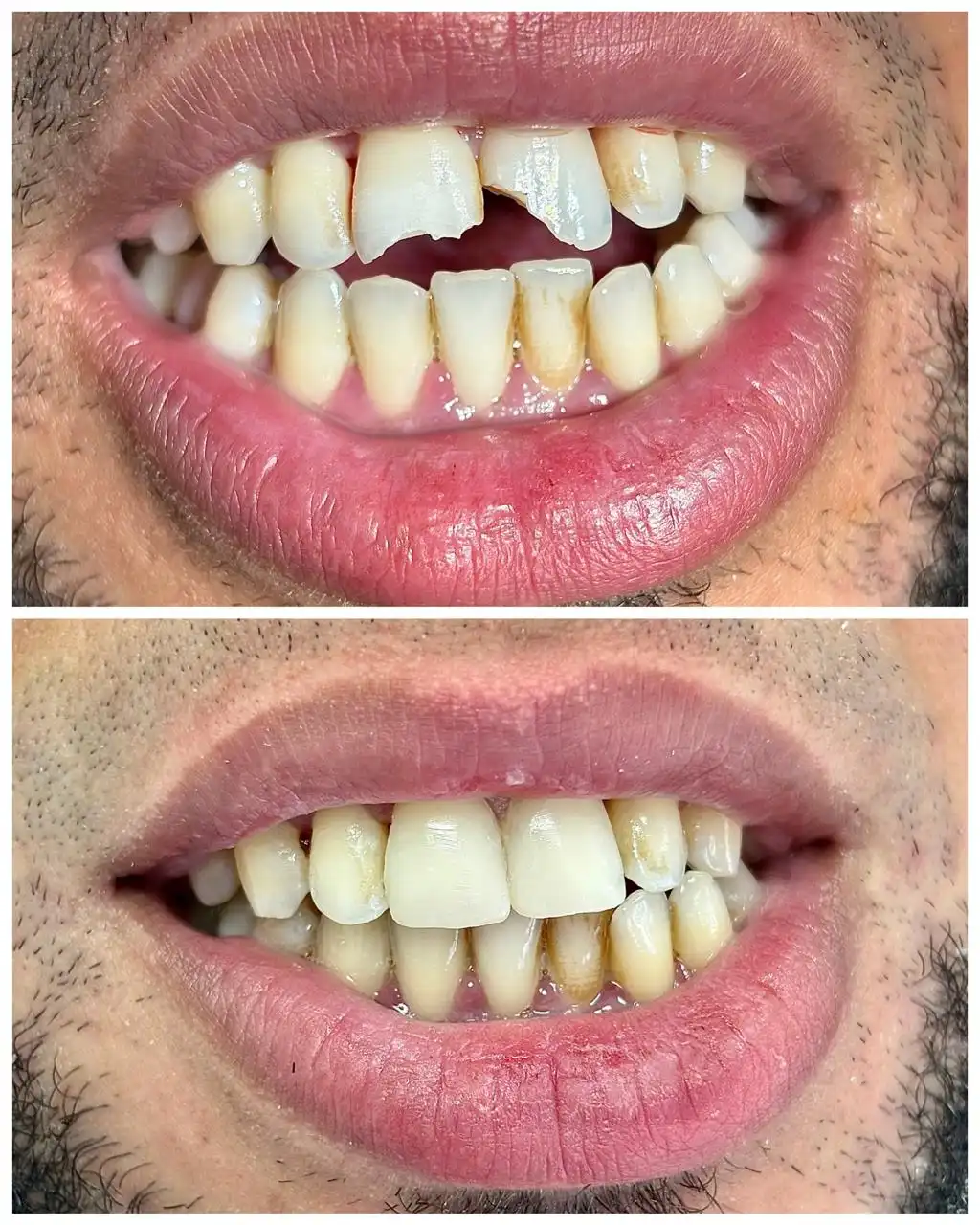 Composite esthétique sourire — Dr. Intissar Ahamout
