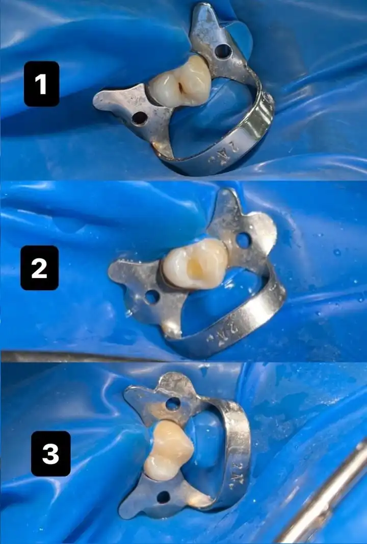 Endodontie traitement de canal Tétouan — Cabinet Dr. Ahamout