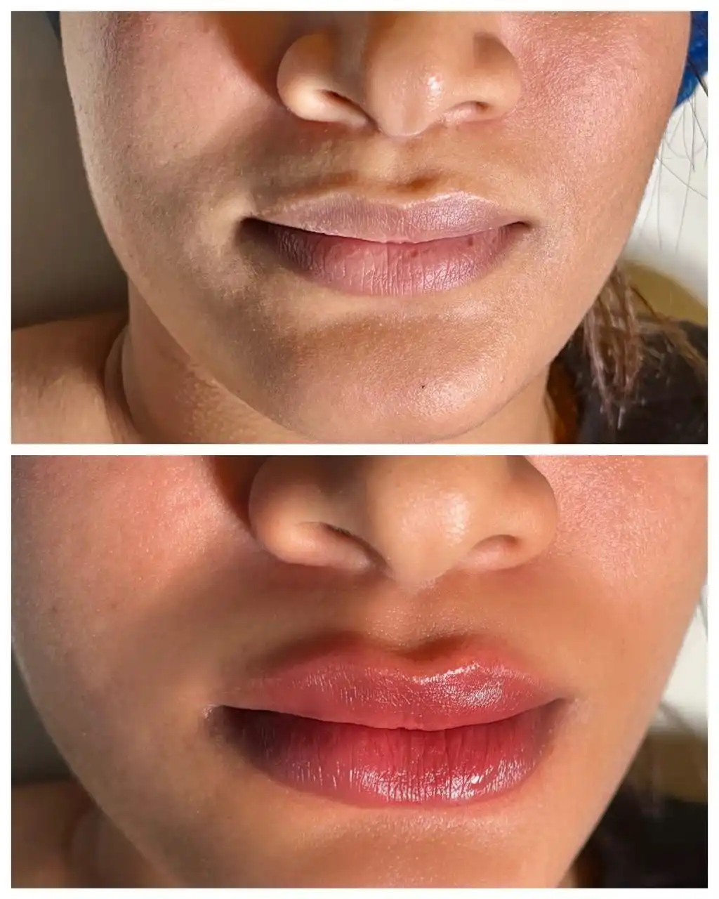 Filler et botox dentiste Tétouan — Dr. Ahamout