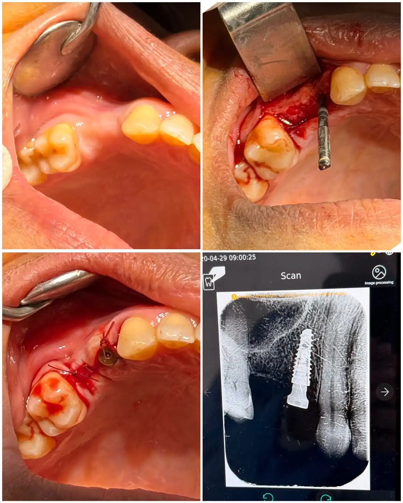 Implant dentaire Tétouan — résultat 1, Cabinet Dr. Ahamout