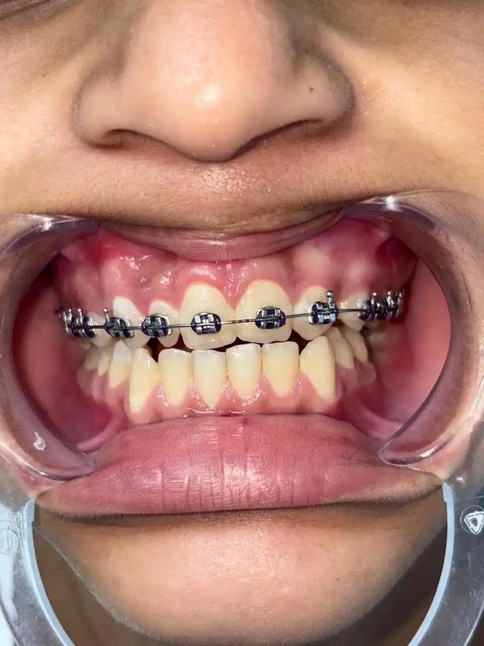 Orthodontie bagues Tétouan — Cabinet Dr. Ahamout