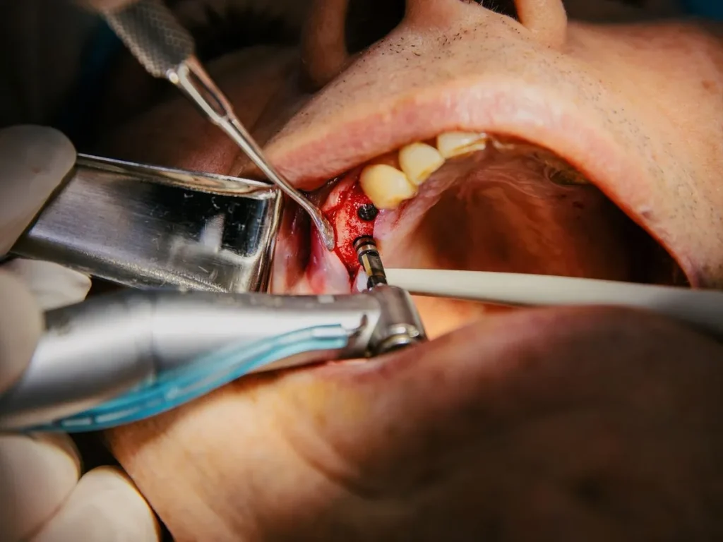 Implant dentaire Tétouan — Cabinet Dr. Ahamout